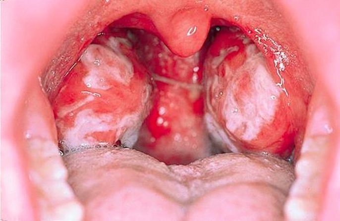 La mononucleosis infecciosa es causada por el virus de Epstein-Baar y causa fiebre, inflamación de los ganglios y faringoamigdalitis.